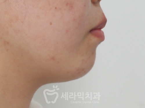 Before and After Orthodontic Treatment for Protruding Mouth and Deep Bite: A Calmer, More Sophisticated Transformation! image 3