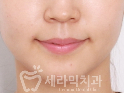 치아교정 전후 확연한 인상 변화! 관련 이미지 8