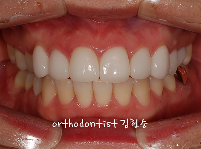 강남 덧니, 돌출 관련 이미지 24