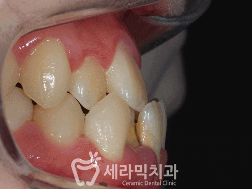 반대교합과 돌출입 고민, 세라믹교정으로 해결 완료! 관련 이미지 3