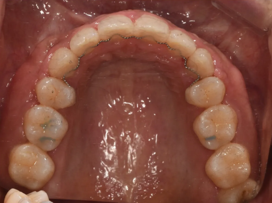과개교합 교정: 비수술로 치료한 토끼 이빨 이야기 관련 이미지 11