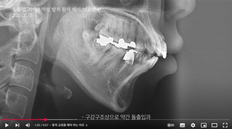 발치교정 vs 비발치교정, 어떤 선택을 해야 후회 없을까? 관련 이미지 1