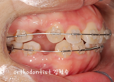 강남 돌출 관련 이미지 21