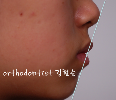 강남 덧니 관련 이미지 9