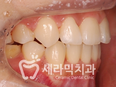 토끼이빨, 틀어진 치아배열 세라믹교정 전후사진 관련 이미지 19
