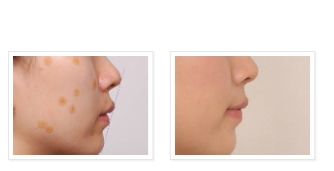 과개교합 ABP 교정 관련 이미지 10