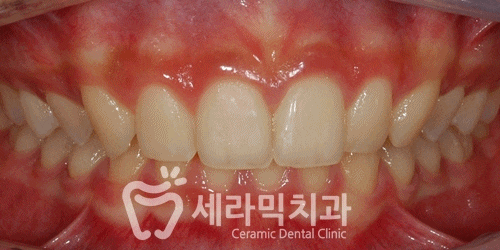 과개교합, 딥바이트 비발치 치아교정전후 관련 이미지 6