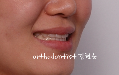 반대 교합 관련 이미지 32