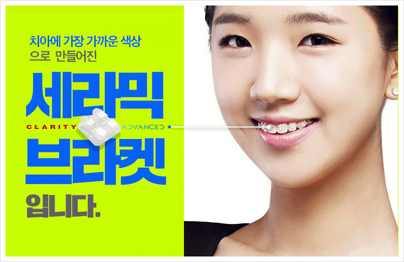 세라믹교정 단점을 보안한 클래러티 어드밴스 ~ 관련 이미지 7