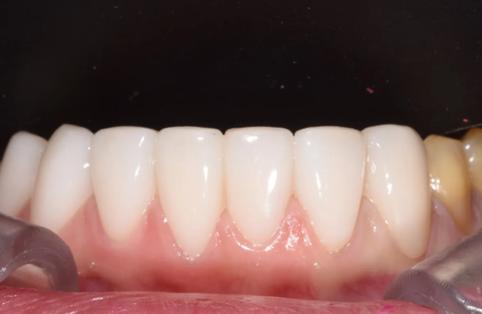 학동역 라미네이트 전후, 치아 모양과 색상 개선 사례 관련 이미지 12