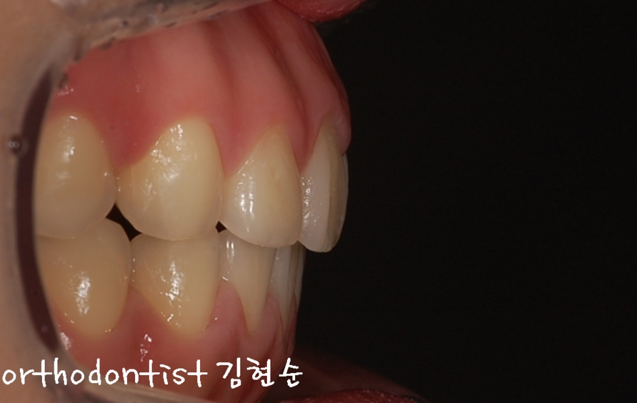 세라믹교정 은 세라믹치과 돌출입교정 관련 이미지 10