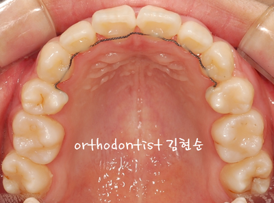 강남 덧니 관련 이미지 25