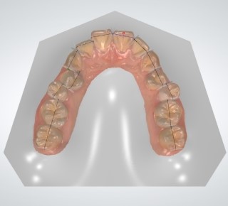 세라믹교정 세라믹치과 - 아나운서 교정이 뭘까요 ? 관련 이미지 5