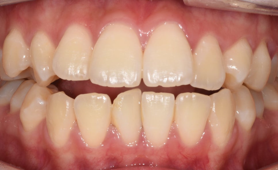 개방교합은 재발률이 높다? 치아교정 후 관리방법 (feat.유지장치) 관련 이미지 3