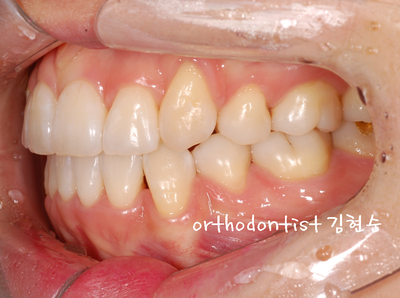 강남 덧니 관련 이미지 23