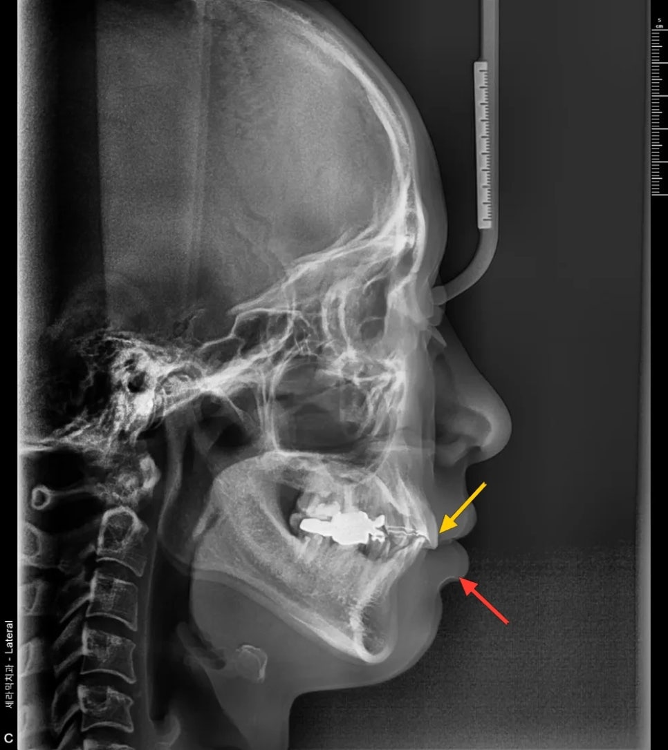 돌출입 재교정, 그것도 세 번째. 관련 이미지 4