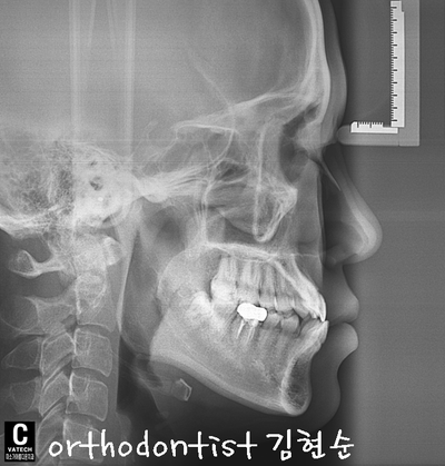 반대 교합 관련 이미지 14
