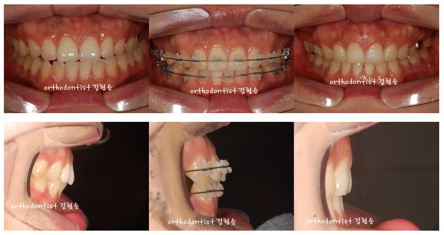 발치 돌출입교정으로 인상개선, 동안 만들기 관련 이미지 8
