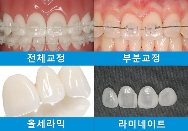 치아교정전후 : 치아사이틈, 벌어진 공간 치아교정으로 치료! 관련 이미지 3