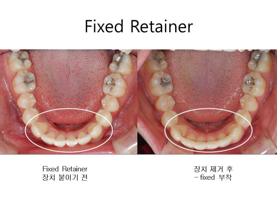학동역치과 치아교정 잘하는 곳 ! 관련 이미지 24