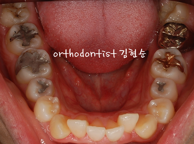강남 돌출 관련 이미지 7