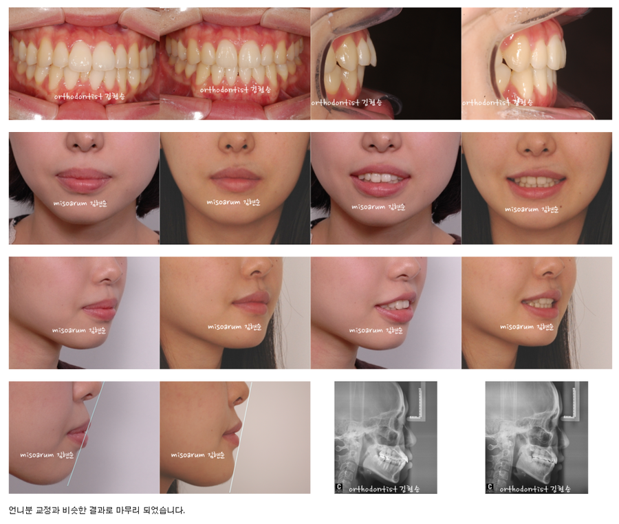 세라믹교정 세라믹치과-돌출입 발치교정 11 관련 이미지 5