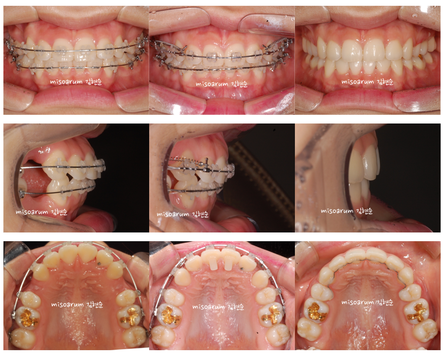 세라믹교정 세라믹치과-돌출입발치교정 9 관련 이미지 3
