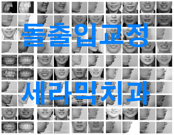 학동역 치아교정, 돌출입 세라믹교정 관련 이미지 5