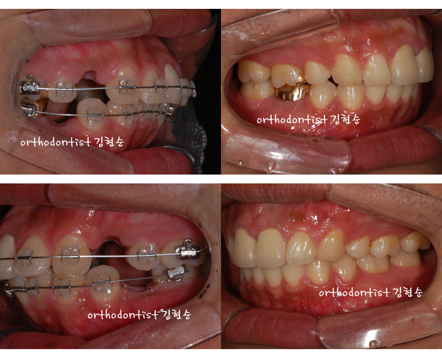 세라믹교정 세라믹치과-돌출입발치교정 1 관련 이미지 5
