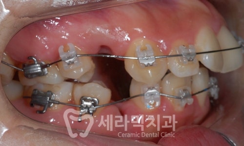 치아교정만으로 세마리 토끼를 한번에! 돌출입, 무턱, 치열불규칙 치아교정전후 관련 이미지 7