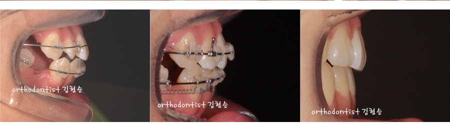 세라믹교정 은 세라믹치과 수술없이 돌출개선 관련 이미지 5