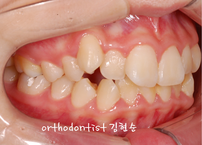 강남 돌출 (토끼 치아) 관련 이미지 9