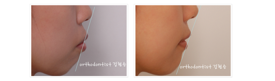 돌출입 발치교정, 미니스크류를 통한 6가지 변화 관련 이미지 11