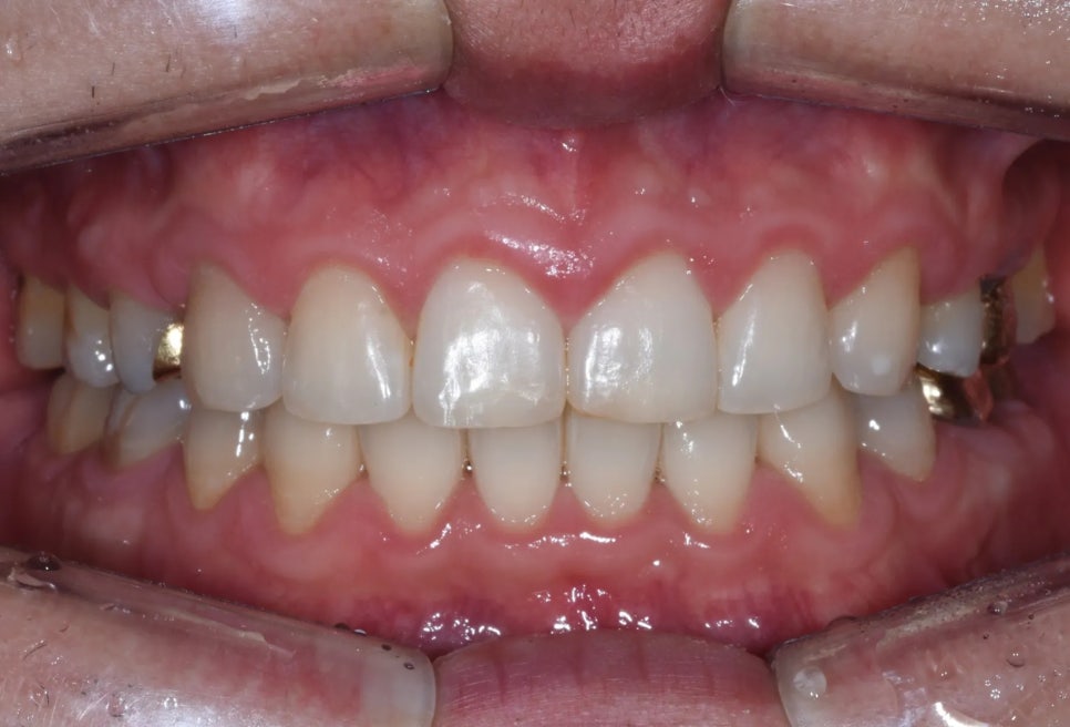 돌출입 재교정, 그것도 세 번째. 관련 이미지 9