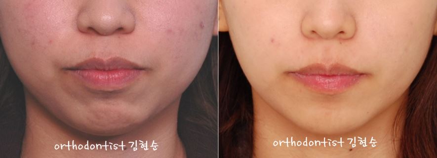 세라믹치과 "돌출입 발치교정" 관련 이미지 9
