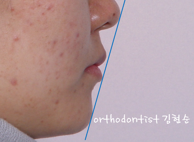 강남 돌출 관련 이미지 11