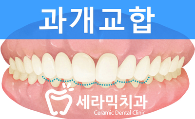 과개교합 치아교정잘하는곳, 세라믹치과 치아교정전후! 관련 이미지 1