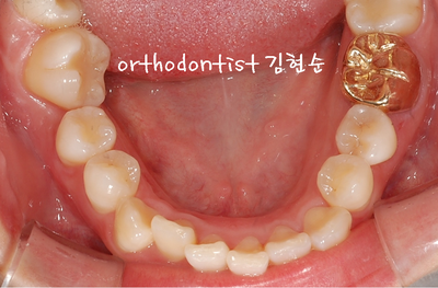 강남 덧니, 돌출 관련 이미지 15