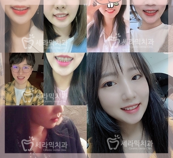 Before and After Orthodontic Treatment for Protruding Mouth and Deep Bite: A Calmer, More Sophisticated Transformation! image 14