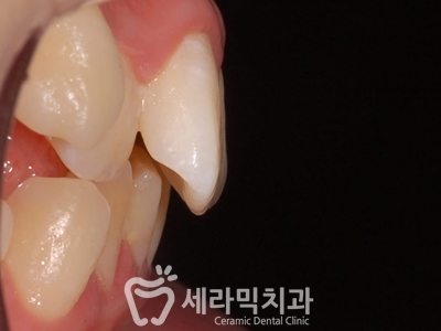 토끼이빨 돌출입 치아교정 전후 표정변화! 관련 이미지 8
