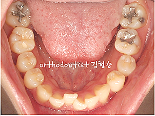 강남 돌출입 교정 관련 이미지 8