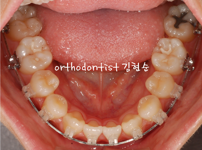 개방 교합 관련 이미지 23