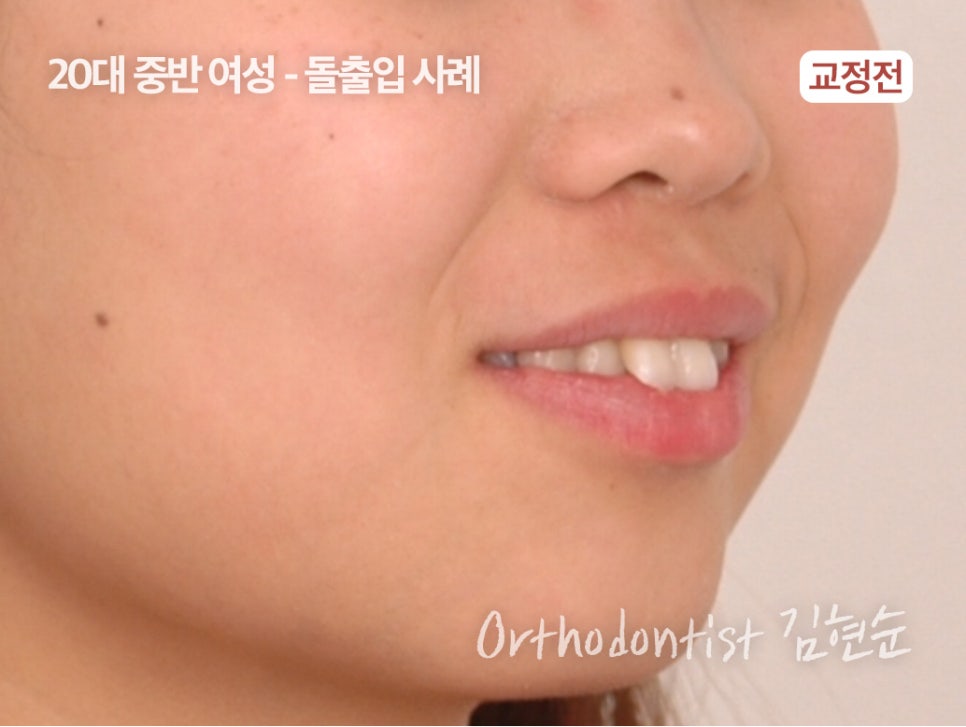 학동역치과 치아교정은 여기서 !! 관련 이미지 3