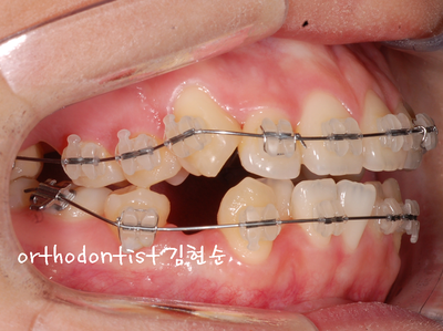치열 교정(치열 불규칙) 관련 이미지 23