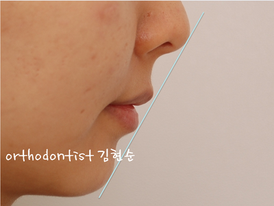 돌출 교정 (비발치 교정/비대칭) 관련 이미지 33