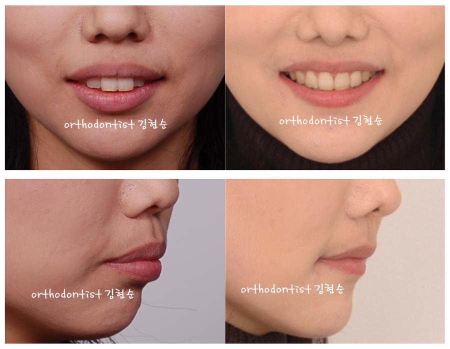 세라믹교정 세라믹치과-돌출입발치교정 10 관련 이미지 8