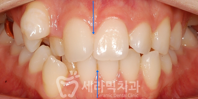 덧니 세라믹교정 전후사진, 학동역 세라믹치과 관련 이미지 3