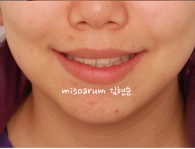 강남치아교정추천 관련 이미지 37