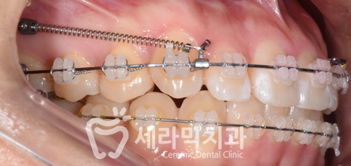 돌출입과 과개교합, 중심선 불일치, 치열불규칙 치아교정전후사진 관련 이미지 5
