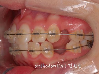 강남 돌출 (토끼 치아) 관련 이미지 23